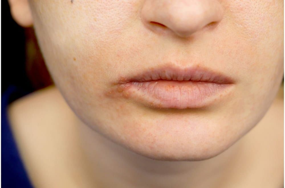 Pigmented Lips Causes Treatment More